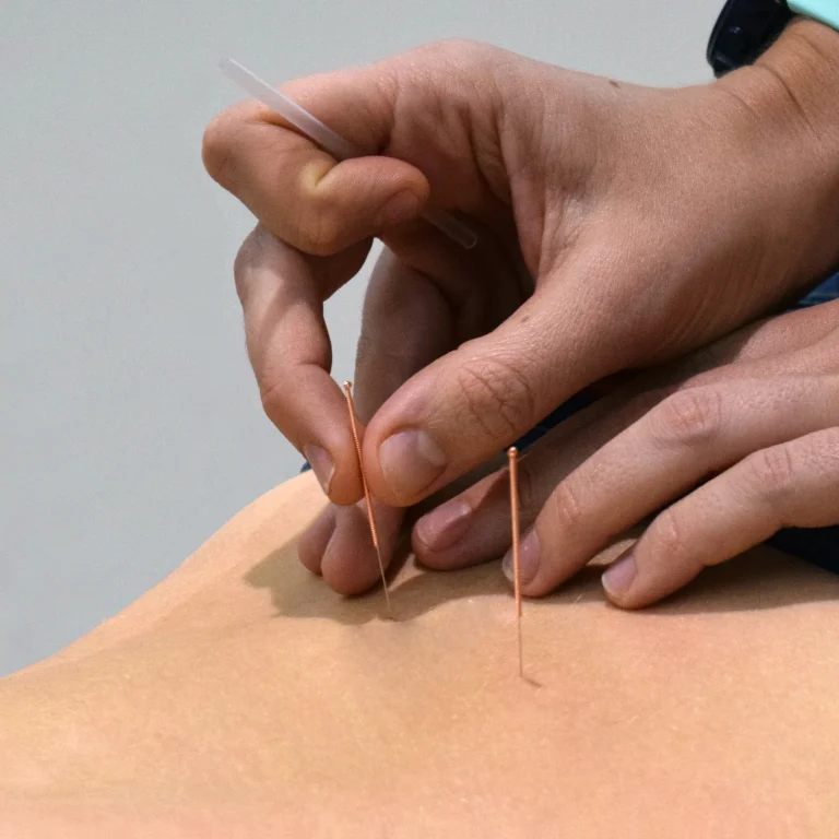 acupuncture needles